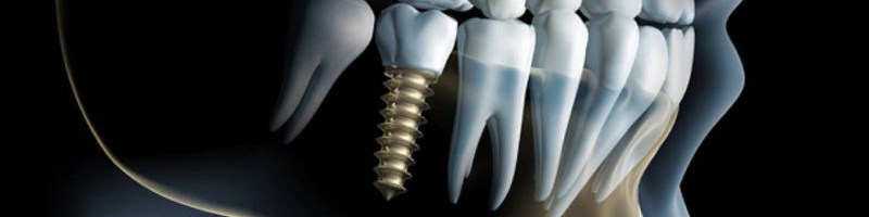 Implanty stomatologiczne